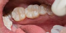 DENTS Zahnästhetik - Behandlung - Inlays