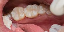 DENTS Zahnästhetik - Behandlung - Inlays DENTS Zahnästhetik - Behandlung - Inlays