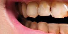 DENTS Zahnästhetik - Behandlung - Kronen DENTS Zahnästhetik - Behandlung - Kronen