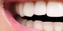 DENTS Zahnästhetik - Behandlung - Kronen