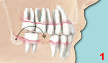 DENTS Kochenaufbau DENTS Kochenaufbau