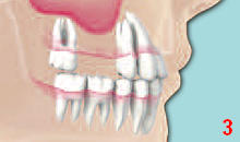 DENTS Sinus-Lift-Operation