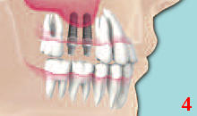 DENTS Sinus-Lift-Operation