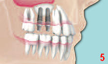 DENTS Sinus-Lift-Operation DENTS Sinus-Lift-Operation