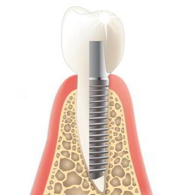 DENTS Implantate - abnehmbar