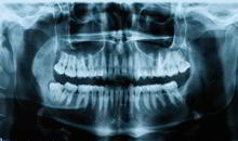 DENTS Implantate - Diagnose