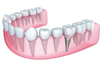 DENTS Implantate - Einzelzahnlücken