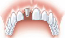 DENTS Implantate - Implantation DENTS Implantate - Implantation