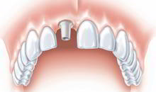 DENTS Implantate - Implantation