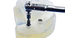 DENTS Implantate - Implantationg DENTS Implantate - Implantation