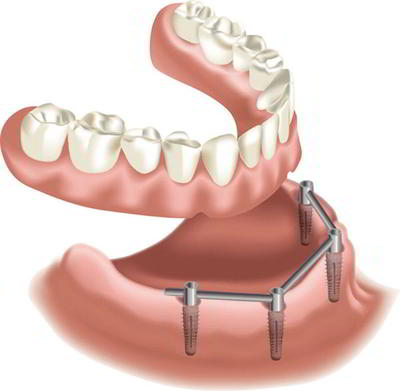 DENTS Implantate - Prothesen