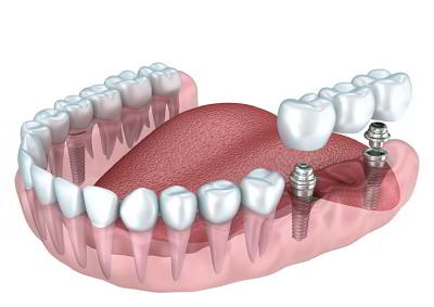 DENTS Implantate - Verkürzte Zahnreihe oder zahnbegrenzte Lücke