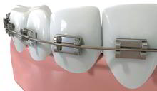 DENTS Implantate - Vorbehandlung DENTS Implantate - Vorbehandlung