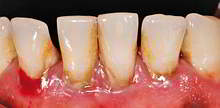 DENTS Zahnästhetik - Mundhygiene-Diagnose