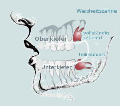 schiefliegende Weisheitszähne