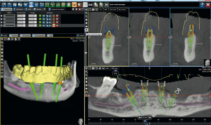 DENTS Implantate - Virtuelle Planung